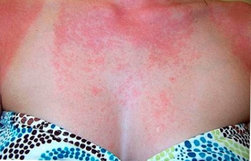 allergiya-na-solntse-2855978